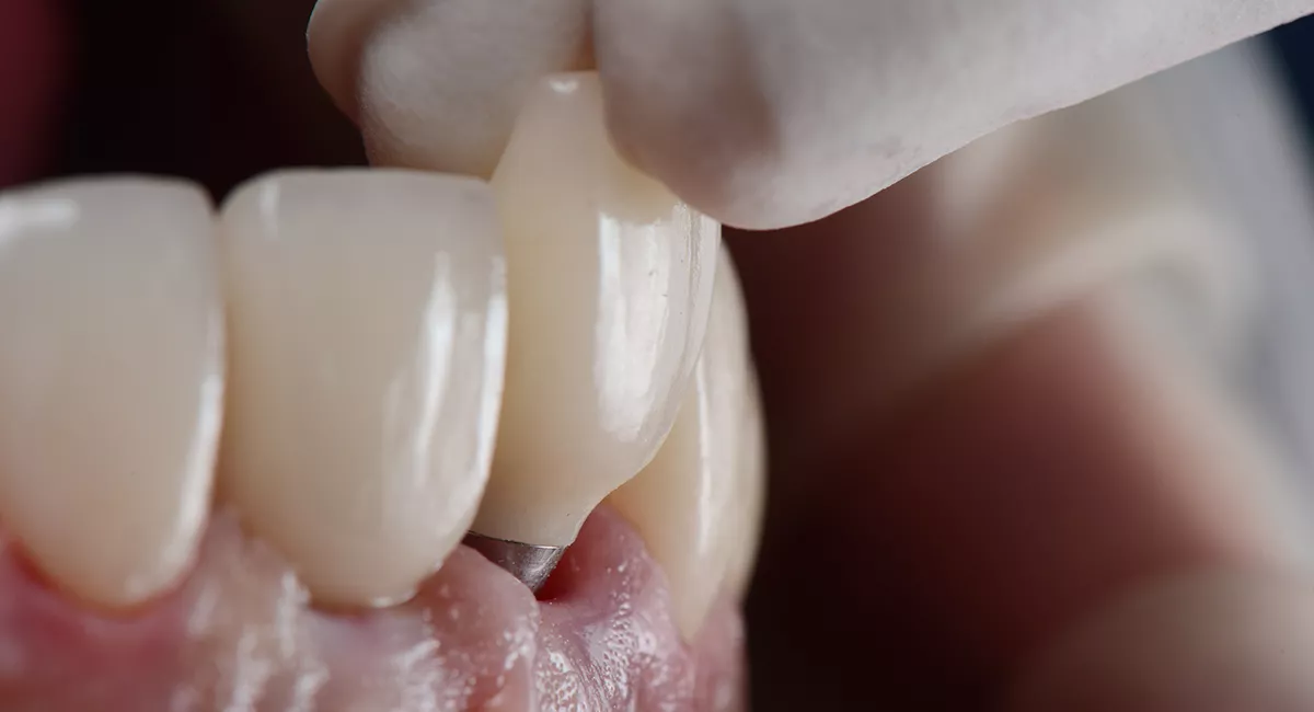 Dental Implant Being Placed