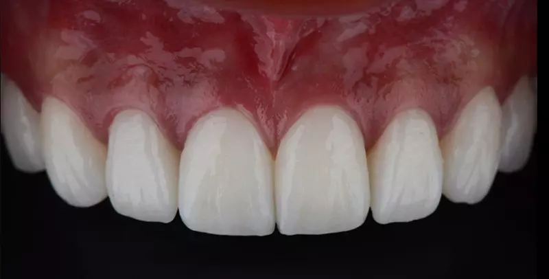 After Porcelain Veneers Treatment