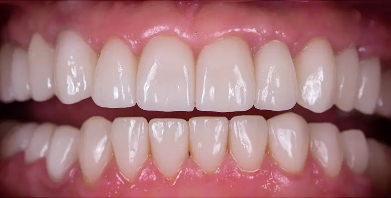 Dental Implants After