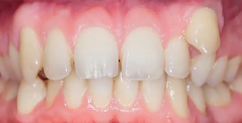 Invisalign Philadelphia Patient Before