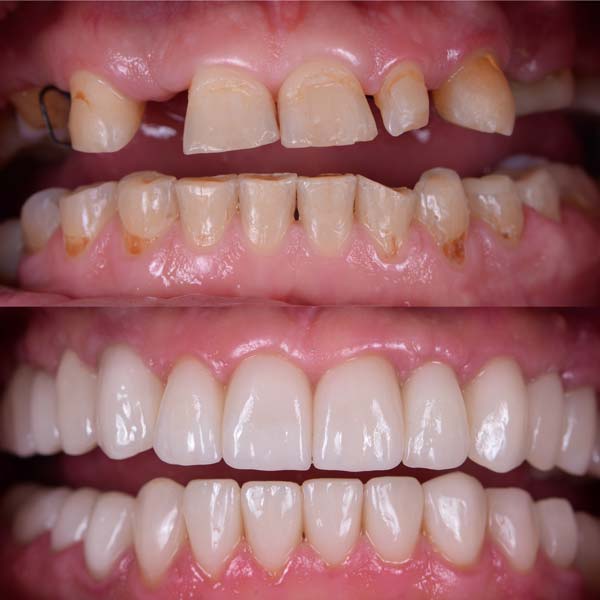 Before & After Dental Implants