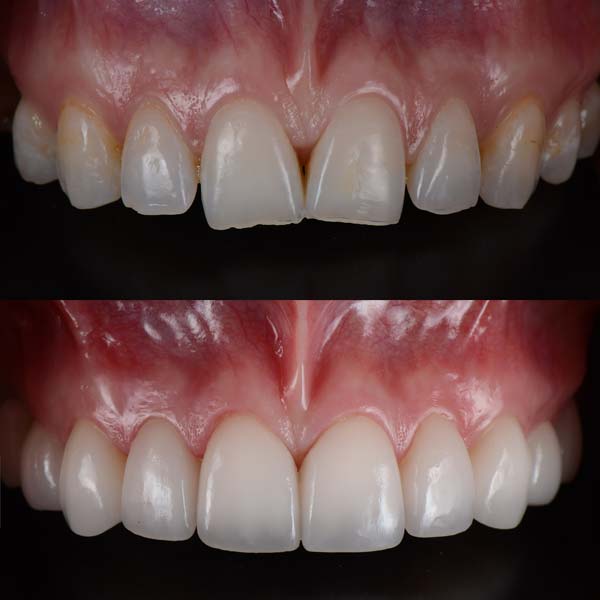 Before & After Patient Porcelain Veneers