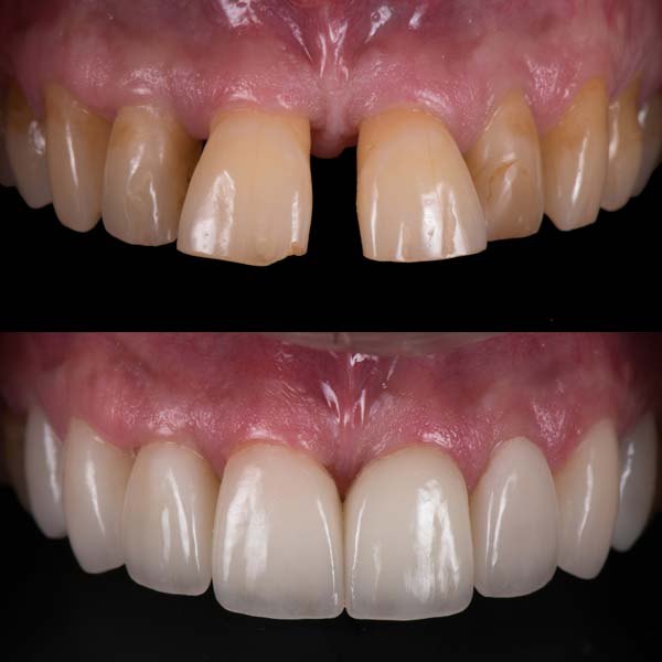 Before & After Porcelain Veneers