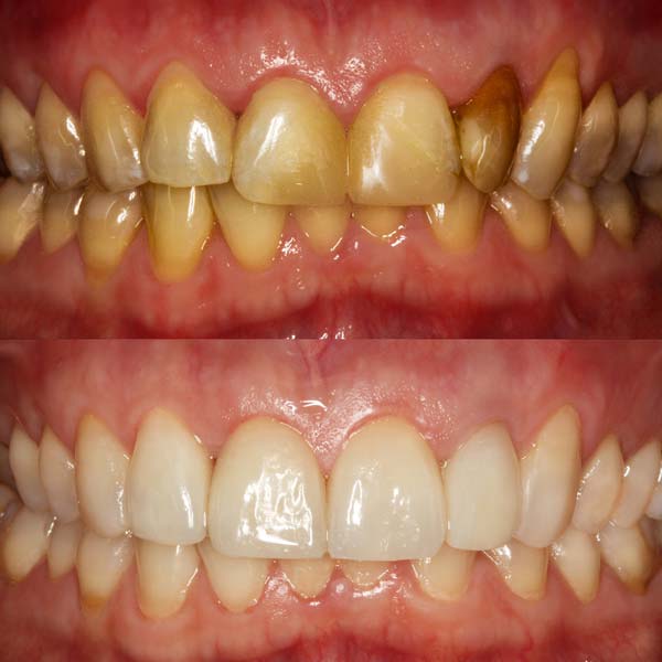 Before & After Teeth Whitening