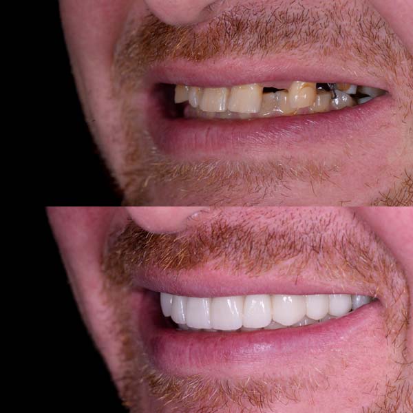 Before & After Dental Implants