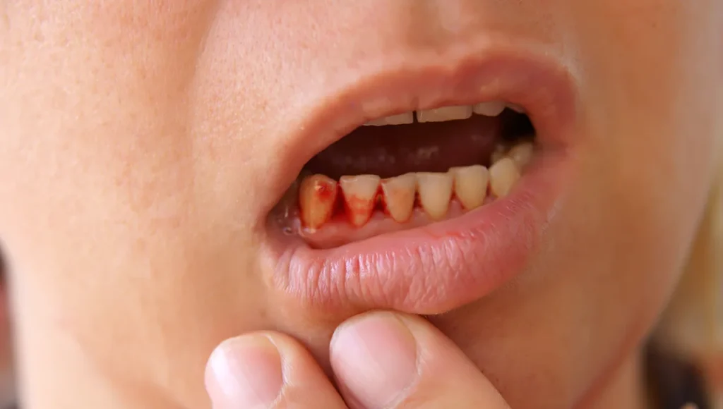 Person with Bleeding Gums