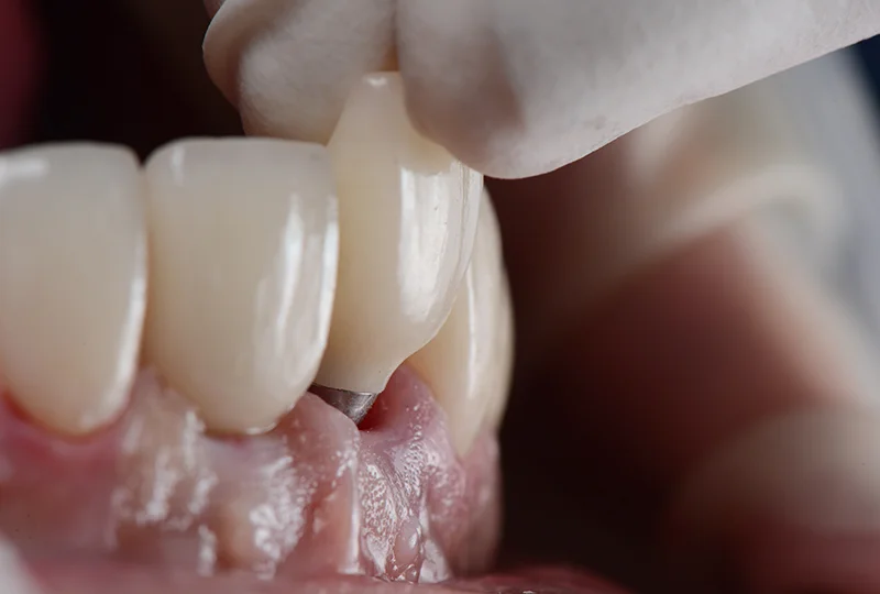 Dentist Placing Dental Implant