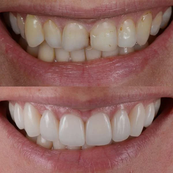 Before & After Porcelain Veneers